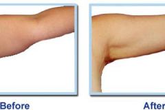 lipotite-arms-before-after-photos