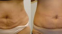 stomach