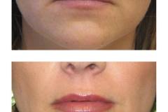 Lip Lift