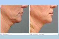 Neck & Chin Lift