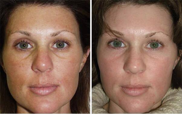 CO2 Laser Skin Resurfacing – Prity Skincare