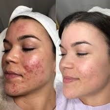 BB Glow Treatment Before and After