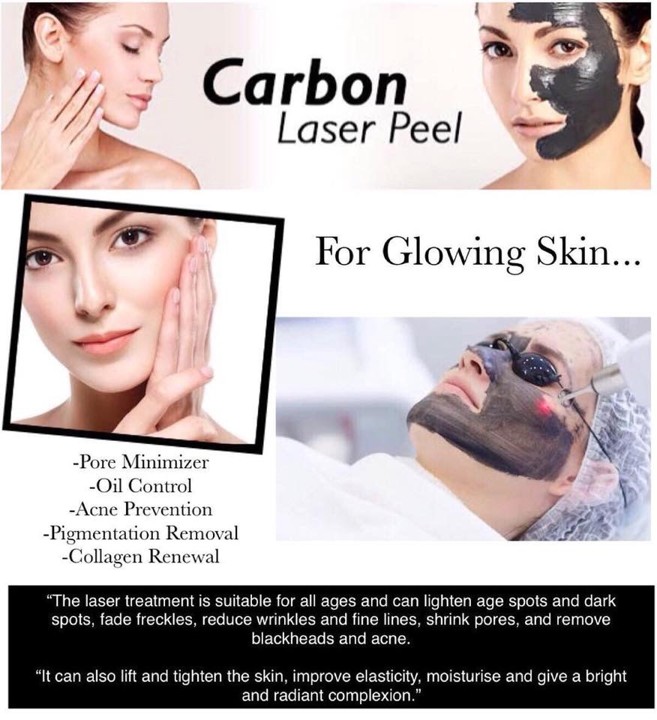 Carbon Laser Peel Facial in Vernon